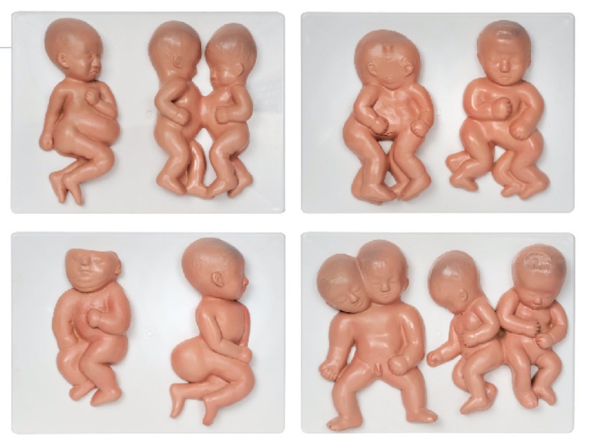 胎儿畸形模型（8部件）