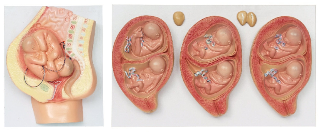 双胎妊娠模型