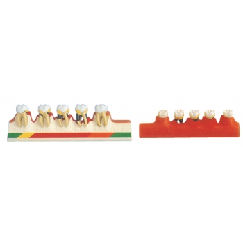 牙周病分类模型